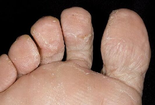 Candidiasi del piede