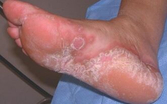 Dermatomicosi acuta del piede