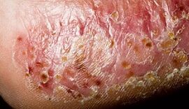 Dermatomicosi