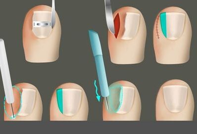 Rimuovere l'unghia in presenza di un fungo sulle gambe