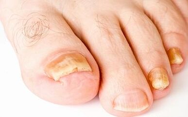 Sintomi fotografici del fungo delle unghie