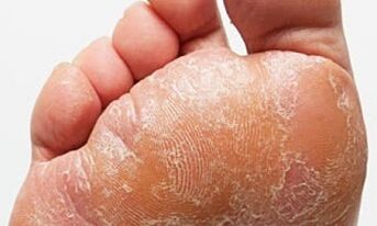 Segni e sintomi di funghi sulle gambe